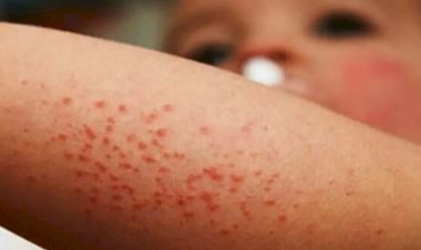 Chihuahua, sin personal médico ante alza de contagios de sarampión
