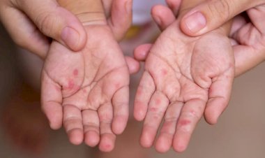 Virus coxsackie refleja crisis en sistema de salud en Oaxaca