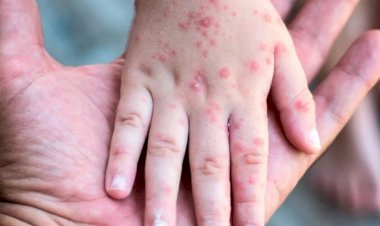 Brote de sarampión, negligencia sanitaria de la 4T