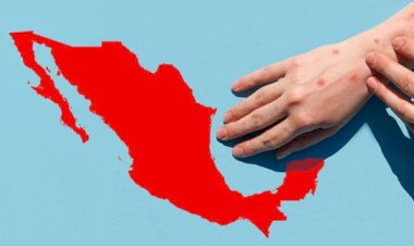 REPORTAJE: El sarampión  regresa a Guanajuato y es urgente contenerlo