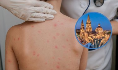 Jalisco, primer lugar en contagios de sarampión